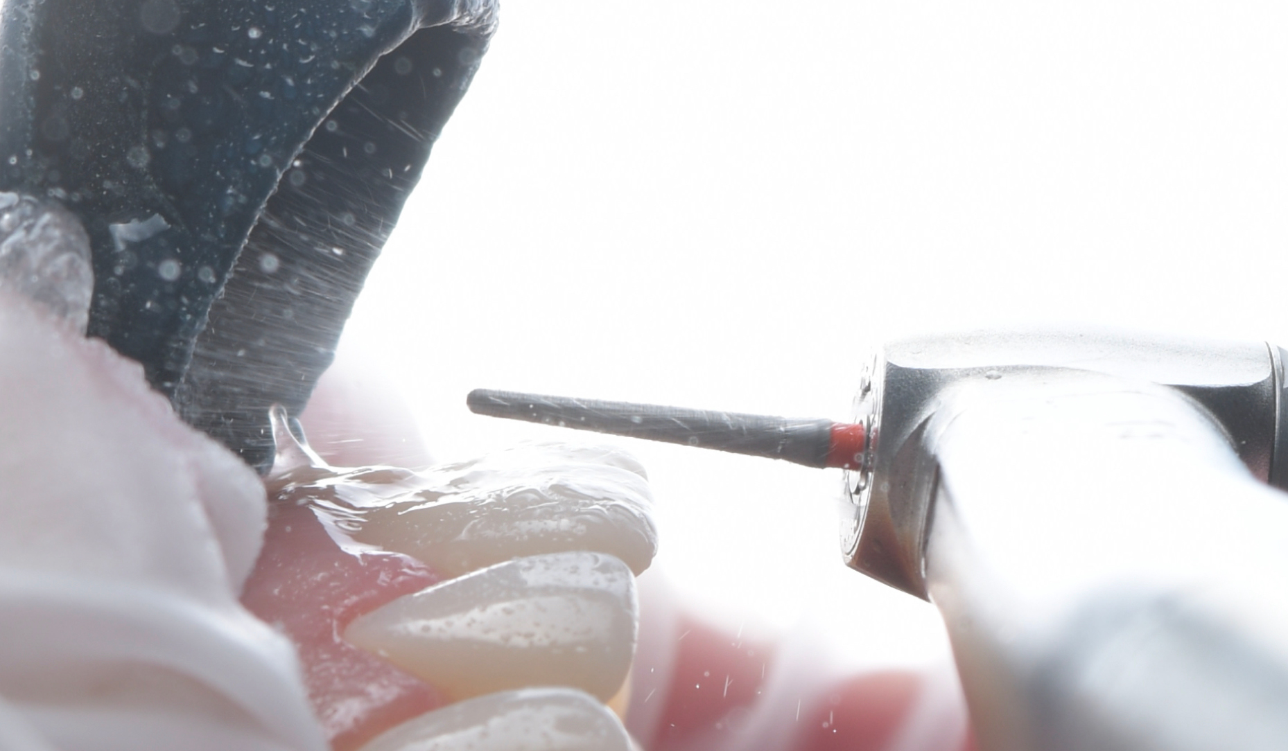 Figure 3: Tooth preparation with rotating instruments.